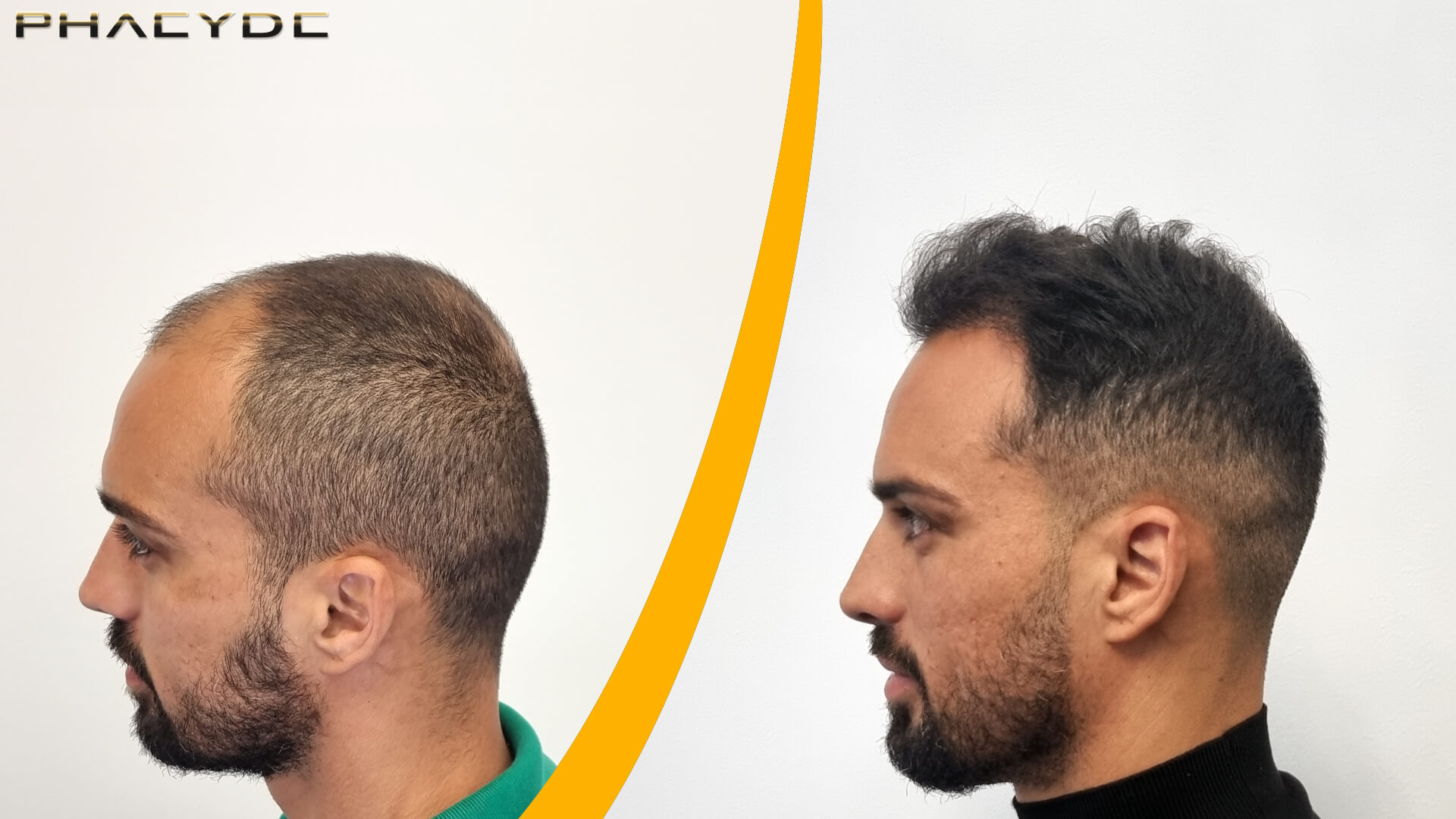 Trapianto di Capelli - Risultato Prima e Dopo