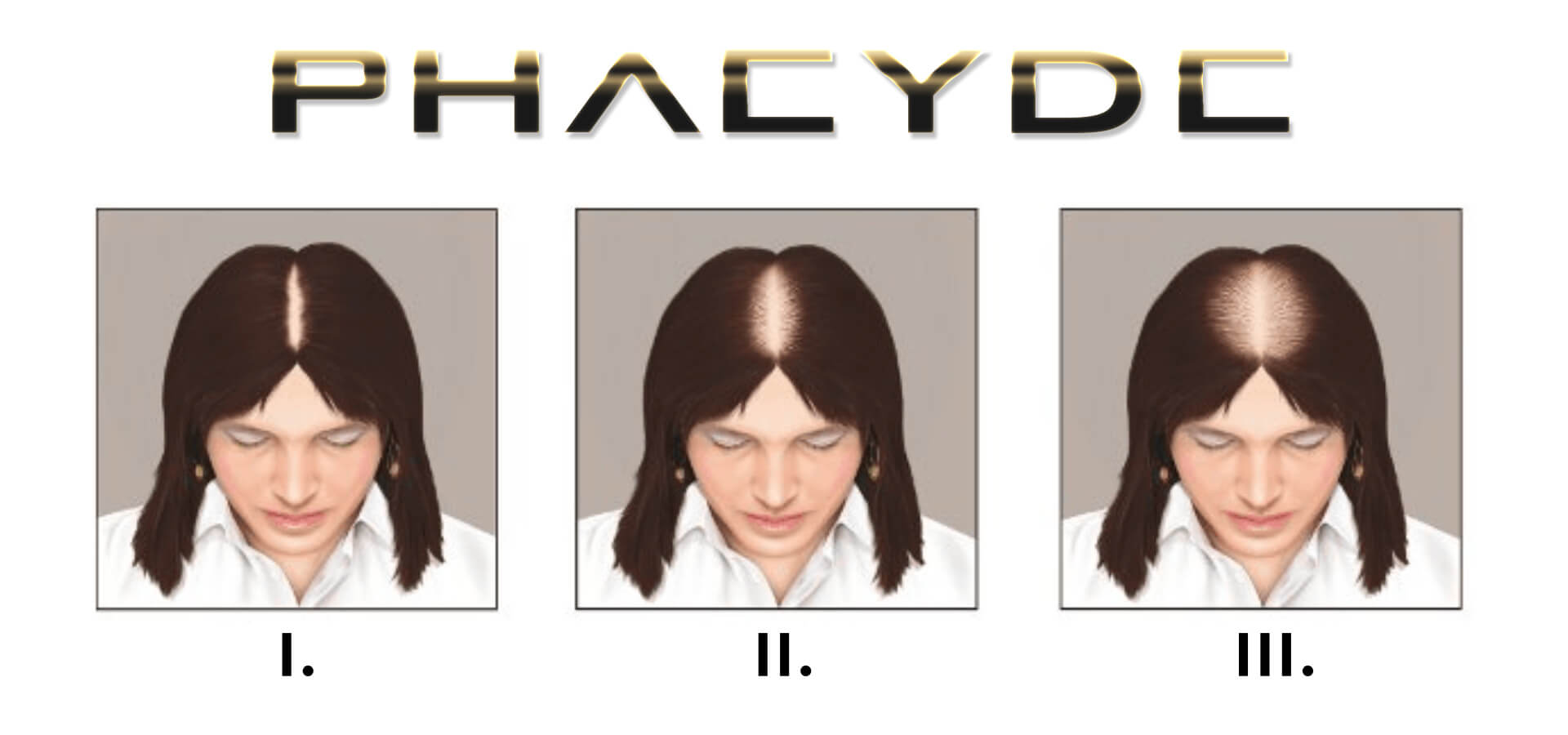 Scala di Ludwig: Stadi della Perdita di Capelli nelle Donne