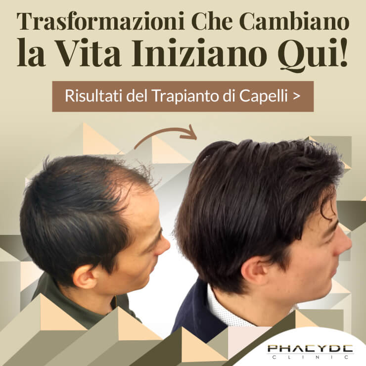 Trapianto di capelli n ° 1 trapianto di capelli